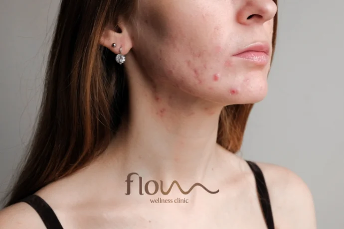 tratamento acne abrantes