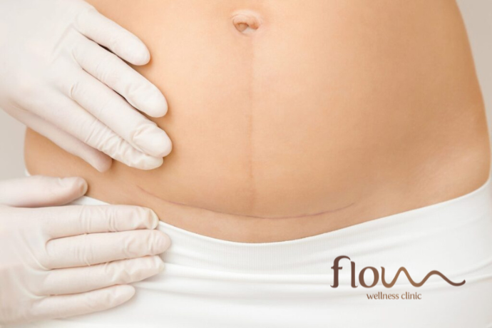 tratamento fibrose pos operatoria
