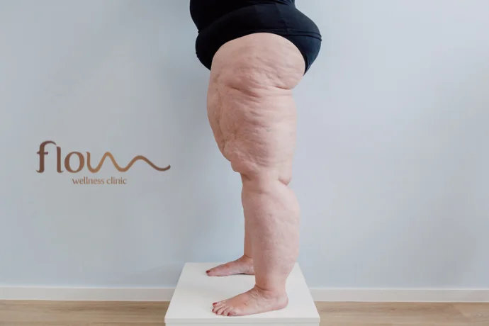 tratamento lipedema abrantes